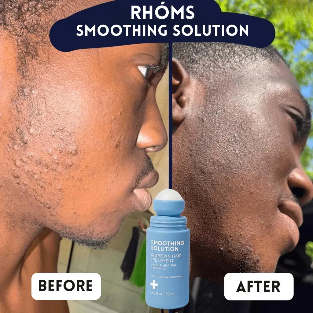 Rhóms Smoothing Solution