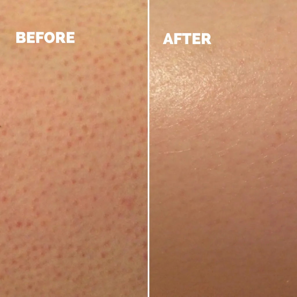 Rhóms KP Smoothing Solution