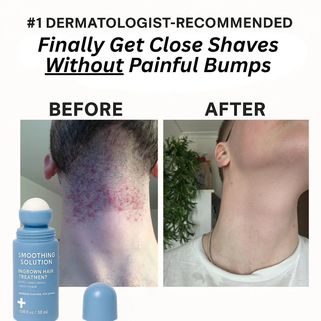 Advanced Roller for Razor Bumps