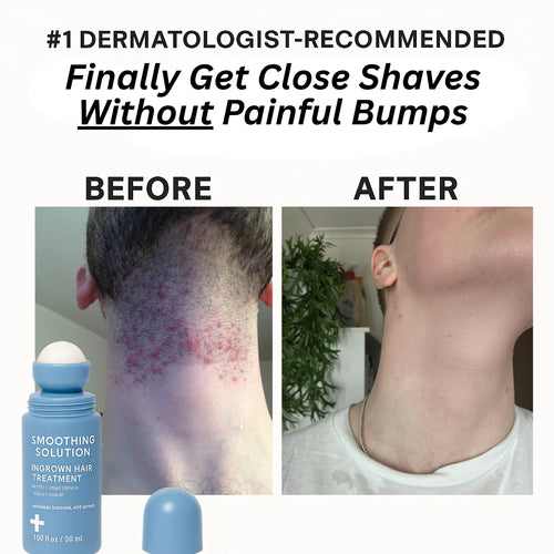 Advanced Roller for Razor Bumps